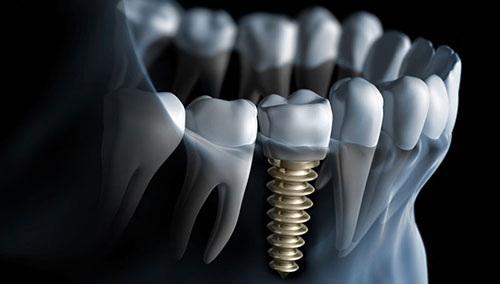 implantat2